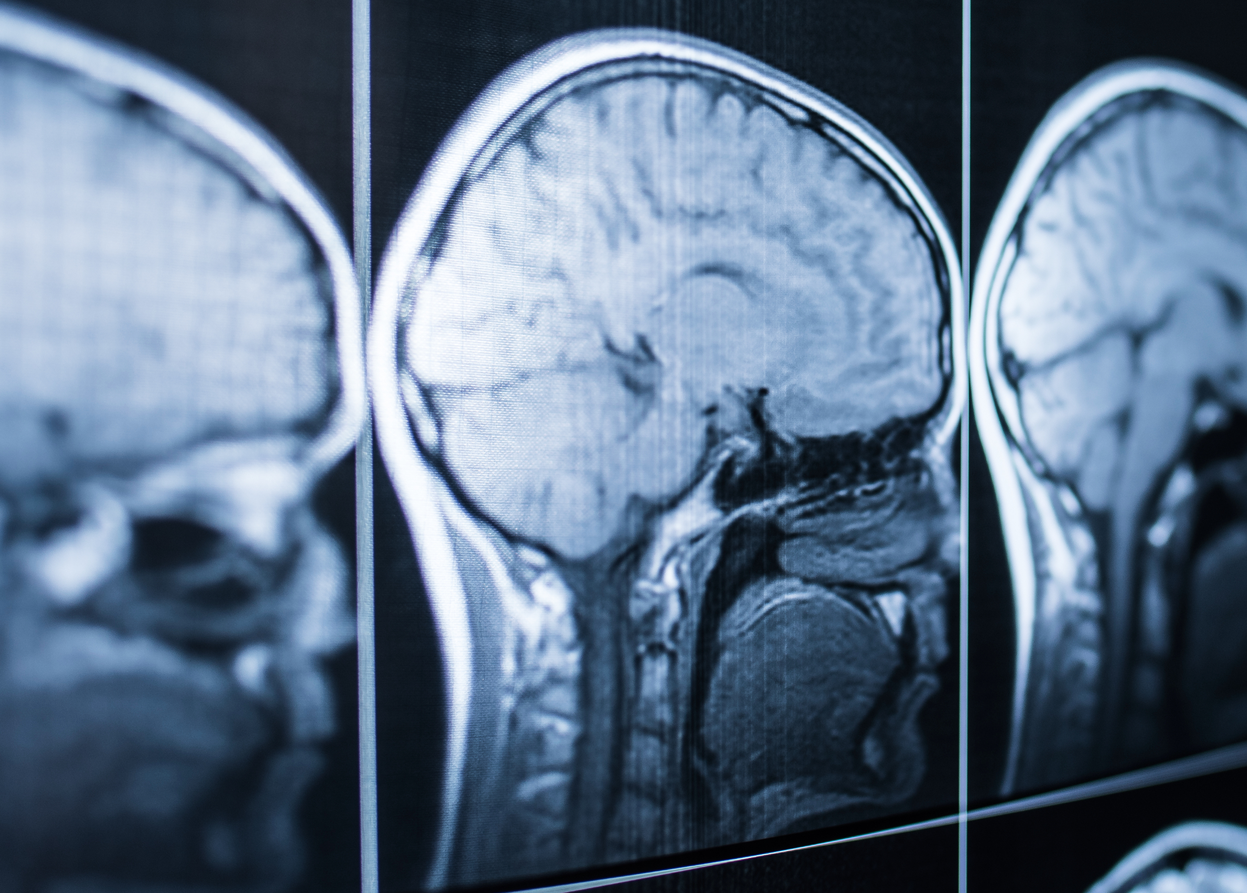 PHILADELPHIA Brain Injury ATTORNEY